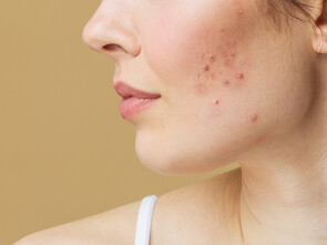 Le manque de fer et de zinc favorise l’acné de la femme adulte.