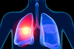 Pollution : les cancers dûs à une réaction inflammatoire