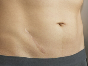 Les cicatrices d'opération d'appendicite sont légion