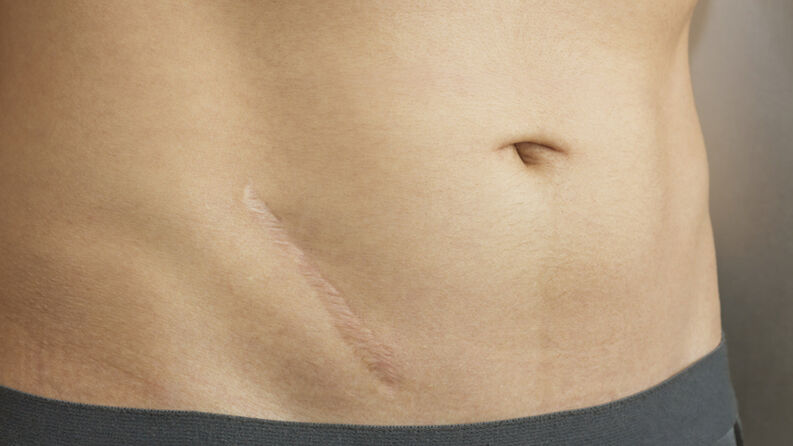 Les cicatrices d'opération d'appendicite sont légion - Alternative Santé