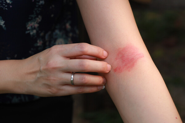 La peau est un émonctoire de secours.