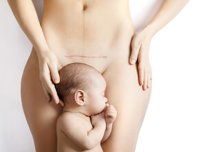 La césarienne influence le microbiote du bébé