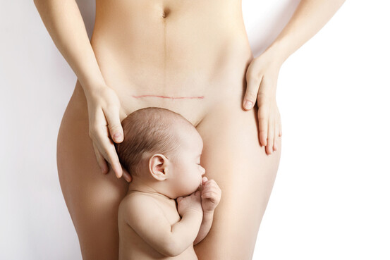 La césarienne influence le microbiote du bébé