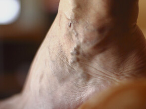 L’insuffisance veineuse est caractérisée par un retour veineux de mauvaise qualité.