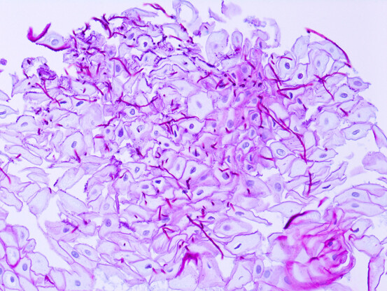 La candidose est une sorte de mycose qui colonise les cavités (intestin, bouche, vagin)
