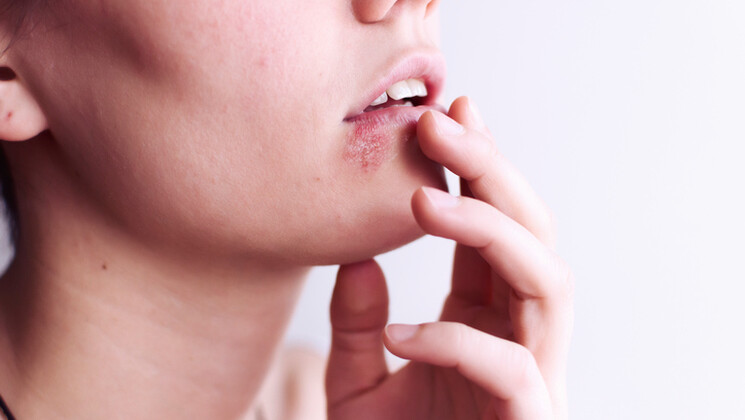 L'herpès pourrait être lié à la maladie parodontale.