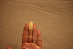 Maladie de Raynaud : les doigts deviennent blancs, cireux ou bleutés.