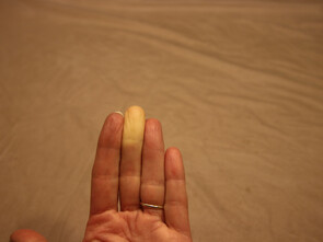 Maladie de Raynaud : les doigts deviennent blancs, cireux ou bleutés.