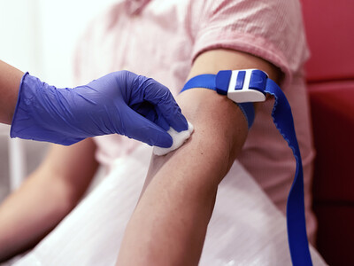 Un simple test sanguin permettrait de détecter les risques d'anévrisme.
